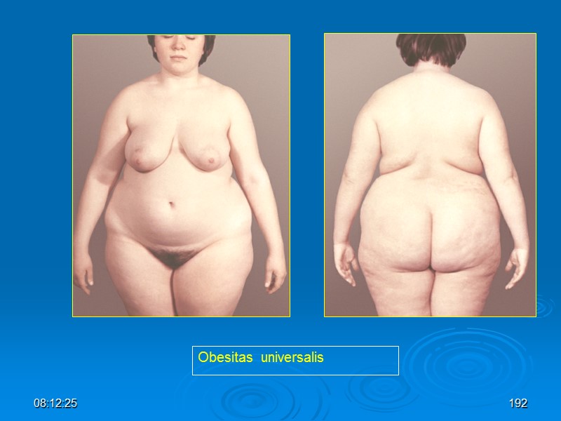 08:12:02 Obesitas  universalis 192